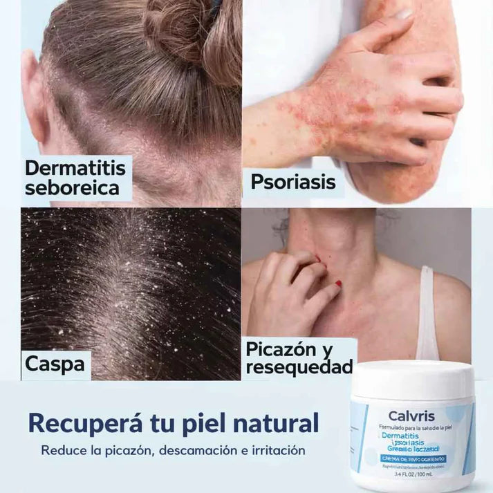 Calvris™: Crema para Alivio de Dermatitis Seborreica y Psoriasis 100% Efectivo